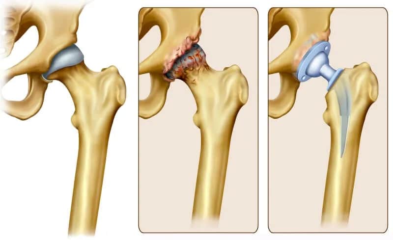 Jakie endoprotezy stawu biodrowego refunduje NFZ i co warto wiedzieć