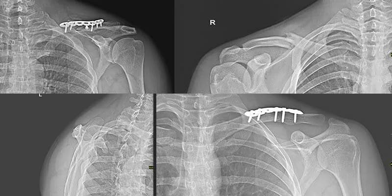 Ile trwa rehabilitacja po złamaniu obojczyka i co warto wiedzieć?
