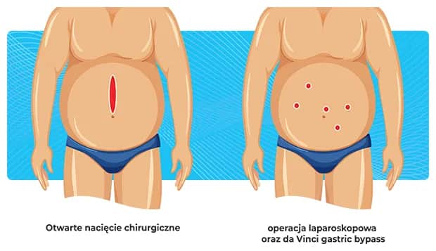 Gdzie wykonać operację bariatryczną na NFZ i uniknąć długiego czekania