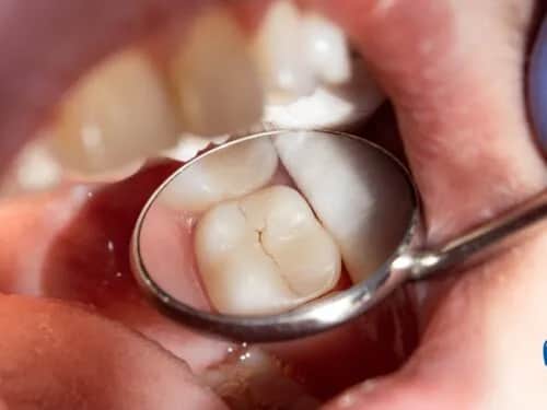 Jakie plomby na NFZ są dostępne? Sprawdź refundowane materiały